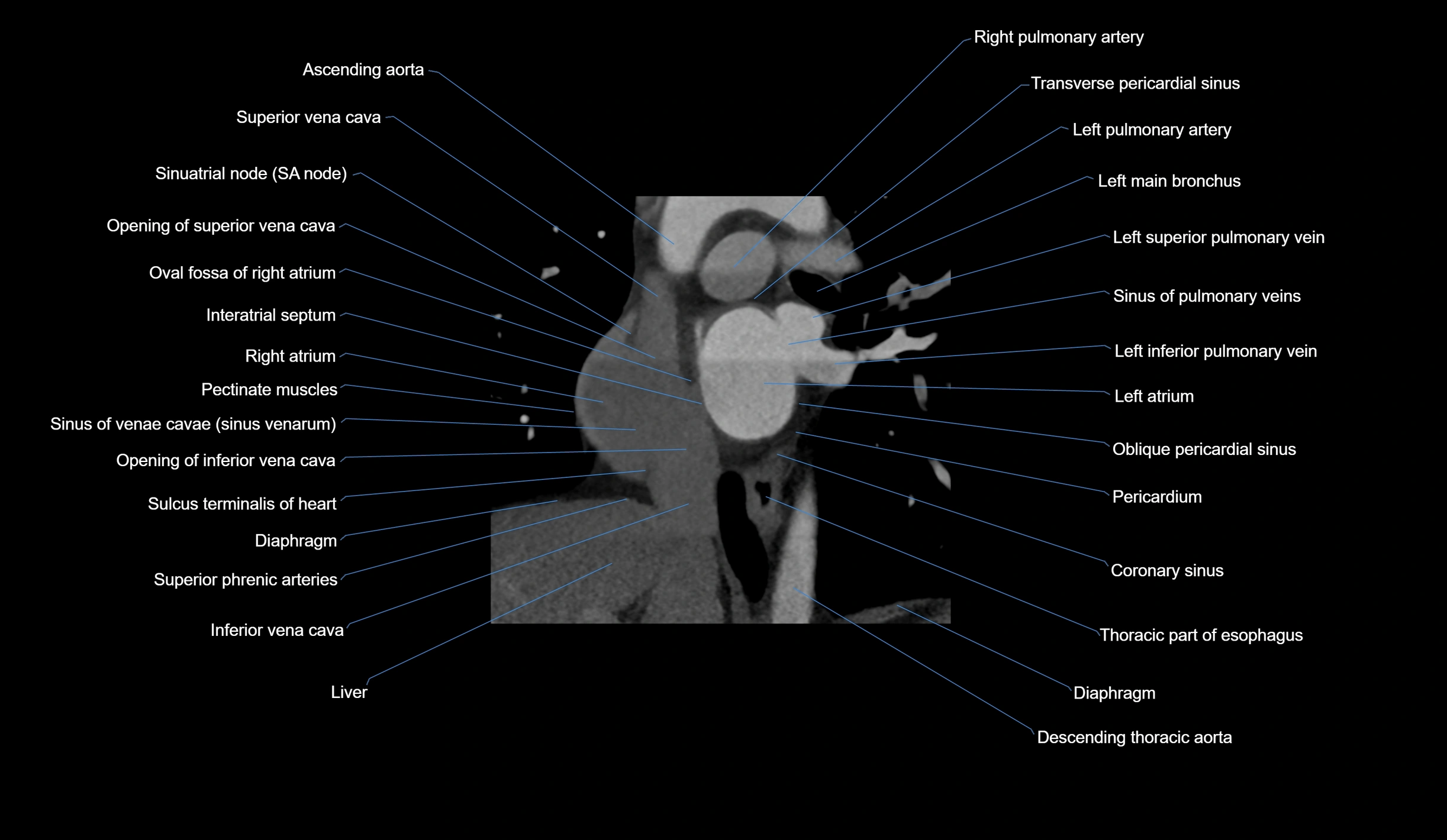 CT heart (coronary angiogram) short axis view  cross sectional anatomy labelled radiology image-00013.webp
